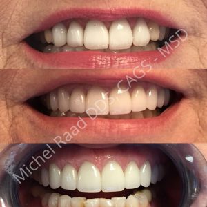 before, in progress, and after results from Luxor Dental