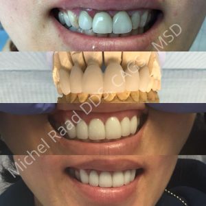 Before and after a smile makeover from Luxor Dental