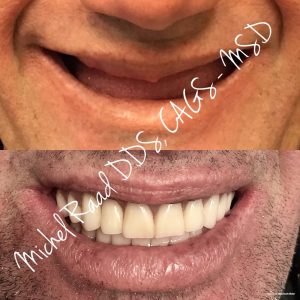 before and after a smile makeover from Michel Raad DDS