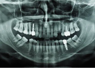 X-ray of teeth